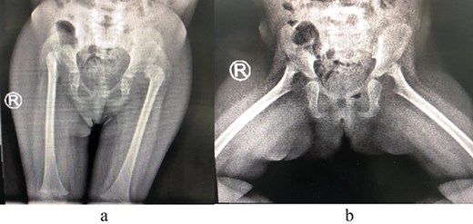 (a) Pre-operative AP view of the pelvis showing bilateral DDH. (b) Pre-operative frog-lateral view of the pelvis showing bilateral DDH.