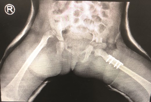 First stage correction of DDH.