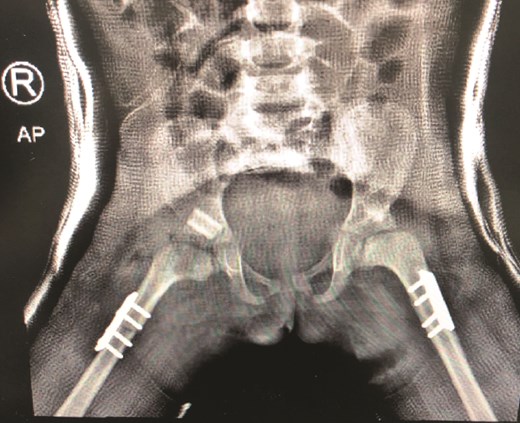 Second stage correction of DDH after 6 months from the first stage procedure.