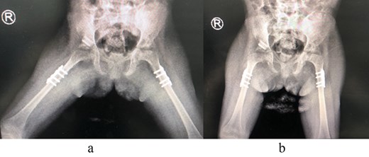 (a) Post spica application lateral view. (b) Post spica application AP view.
