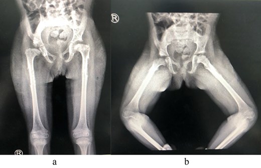 (a) Post removal of implant AP view. (b) Post removal of implant lateral view.