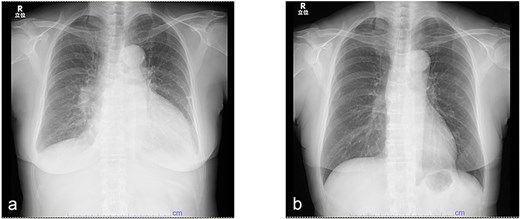 Serial changes in chest radiography. (a) Chest radiograph at initial presentation showing cardiomegaly with a cardiothoracic ratio of 61%. (b) Follow-up chest radiograph after 3 months demonstrating marked improvement in cardiac enlargement.