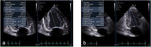 Echocardiographic improvement after urinary decompression. (a) Initial transthoracic echocardiogram showing severely reduced left ventricular systolic function with a Simpson’s ejection fraction (EF) of 24%. (b) Repeat echocardiogram at 3 months showing significant recovery, with EF improved to 73%.