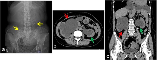 Initial kidney, ureter, and bladder (KUB) and computed tomography (CT) findings. (a) KUB on admission showing a right ureteral stone in the pelvic region and a left ureteral stone in the upper ureter (U1). (b) Axial CT image demonstrating marked bilateral hydronephrosis. (c) Coronal CT image confirming severe bilateral hydronephrosis.