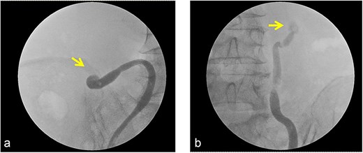 Intraoperative findings during attempted ureteral stenting. Retrograde pyelography demonstrated no passage of contrast agent across the site of the impacted ureteral stone, rendering ureteral stent placement unsuccessful.