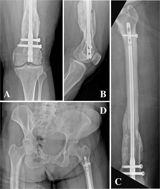 (A, B) Anteroposterior and lateral radiographs showing hypertrophic non-union of the distal femur with retained intramedullary nail and locking screws. (C) Anteroposterior view demonstrating a femoral nail inserted via a distal entry point with abnormal proximal extension. (D) Anteroposterior pelvis radiograph showing the antegrade-design nail extending proximally from a retrograde entry point, terminating proximal to the lesser trochanter.