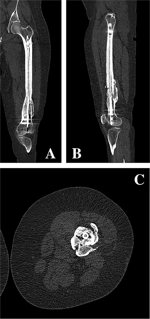 (A, B) Coronal and sagittal CT reconstructions of the left femur demonstrating an intramedullary femoral nail with extensive hypertrophic callus formation at the site of a chronic distal femoral malunion, along with an oblique proximal periprosthetic fracture adjacent to the proximal locking screw. (C) Axial CT image demonstrating hypertrophic callus consistent with a distal femoral malunion surrounding an intramedullary femoral nail.
