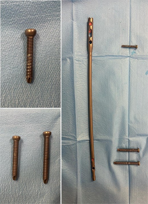 Extracted femoral intramedullary nail and locking screws displayed on a sterile field. The implant’s design confirms it is an antegrade nail, despite its prior insertion through a distal (retrograde) entry point.
