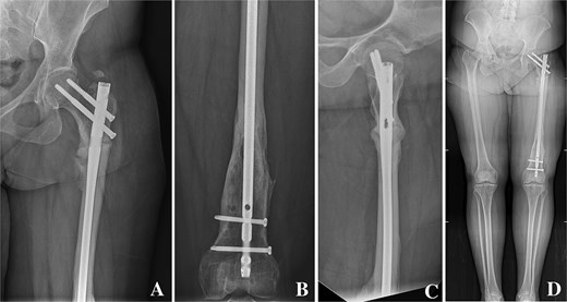 (A, B) Anteroposterior radiographs of the proximal and distal femur showing a correctly positioned antegrade femoral nail inserted via the appropriate proximal entry site. (C) Lateral radiograph of the femur showing stable fixation with appropriate screw placement and no evidence of cortical breach. (D) Scanography of the lower limbs demonstrating restored mechanical alignment.