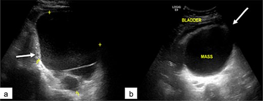 Pelvic ultrasound showing a large multilocular pelvic mass (arrow), displacing the bladder anteriorly.