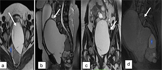 Pelvic MRI. Axial (a), sagittal (b), and coronal (c) T2-weighted images, and sagittal T1-weighted image showing a large multiloculated sacrococcygeal mass containing cystic areas with low T1 signal and high T2 signal (arrow), hemorrhagic components, and fatty components with high T1 and T2 signal (asterisk). No diffusion restriction or contrast enhancement is observed after gadolinium administration.