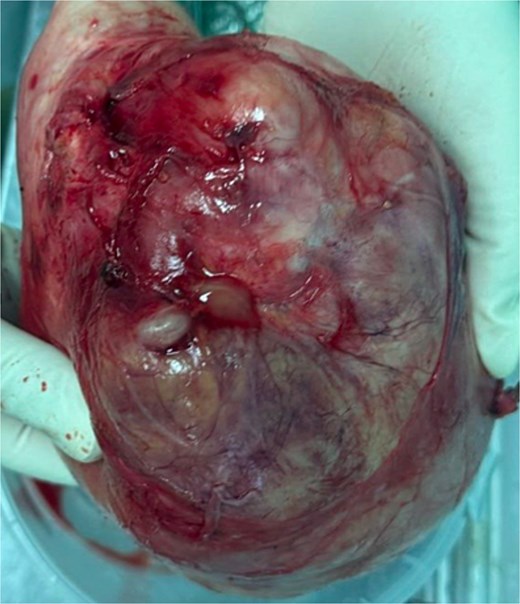 Surgical specimen of the pelvic mass.
