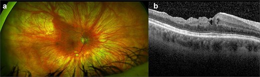 (a, b) Right eye coloured fundus photograph and macular OCT horizontal scan after right vitreous biopsy and intravitreal injection of antibiotics showing residual epiretinal membrane and loss of retinal lamination.