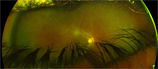 Right eye coloured fundus photograph after anterior chamber washout, 23G vitrectomy, vitreous cavity washout, large pseudomembrane peeling from posterior pole and a second intravitreal injection of vancomycin/amikacin 0.1 ml + periocular injection of triamcinolone showing a large full thickness macular hole.