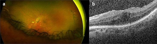 (a, b) Left eye coloured fundus photograph and macular OCT horizontal scan after left vitreous biopsy, intravitreal injection of antibiotics and removal of the dislocated steroid implant from the anterior chamber showing residual epiretinal membrane and cystoid macular oedema.