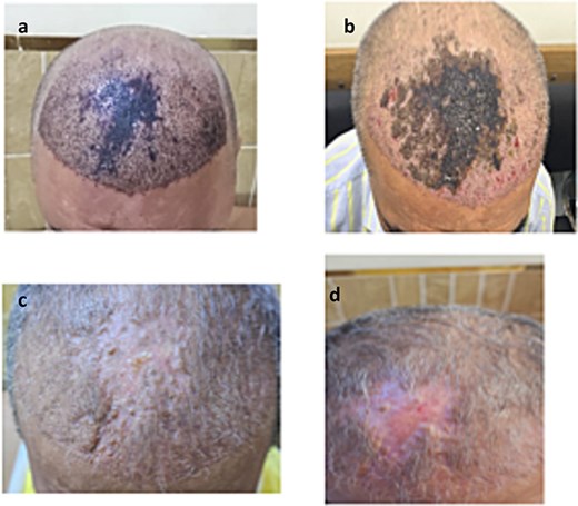 Clinical progression of recipient-site necrosis following follicular unit extraction (FUE). (a). Early postoperative dusky violaceous discoloration of the central frontal scalp, suggestive of impending ischemia. (b). Development of yellowish crusting and extensive necrosis involving the central frontal region. (c). Following systemic antibiotics and daily conservative wound care, crust resolution with formation of early atropic scar. (d). 12-week follow-up showing complete epithelialization of the necrotic recipient site, resulting in a stable atrophic scar with telangiectasia and permanent alopecia confined to the affected area.
