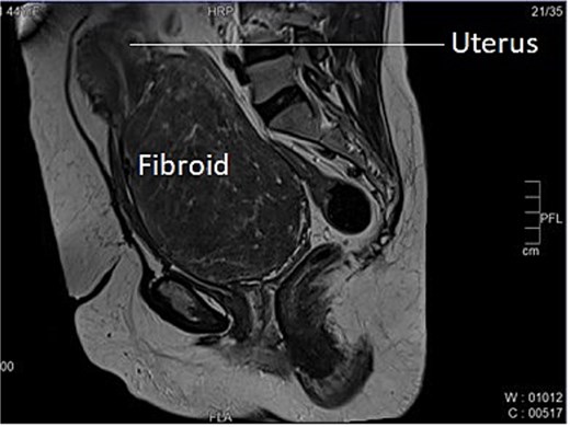 Longitudinal section of MRI image of Case 1 – shows uterus sitting on the top of large cervical fibroid, giving the appearance of a lantern on saint Paul’s dome.
