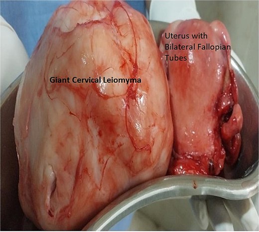Histopathology specimen image of Case 1 – showing uterus with bilateral fallopian tube removed and large cervical myoma. Here, cervical myomectomy preceded total hysterectomy with bilateral salpingectomy.