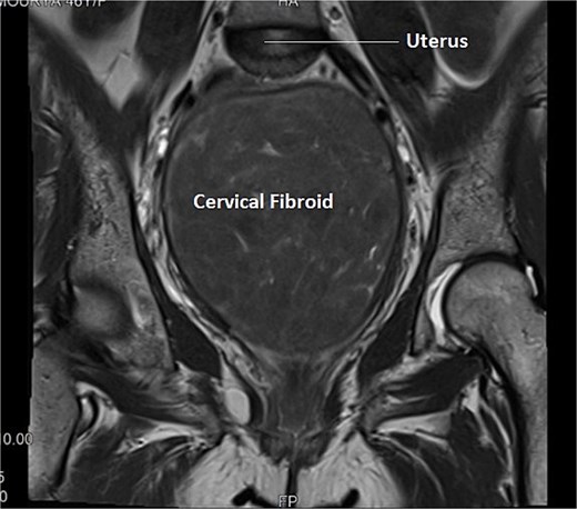 Transverse section of MRI of Case 2 – similar multi-sequential transverse sections aids in clear delineation of course of ureter and its relationship with uterine artery in this case of distorted anatomy because of giant cervical fibroid.
