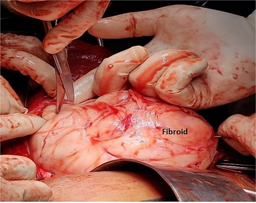 Intra-operative image of Case 2 – myomectomy done with fine dissection with the help of scissors and electrocautery rather than blunt dissections to minimize the blood loss.