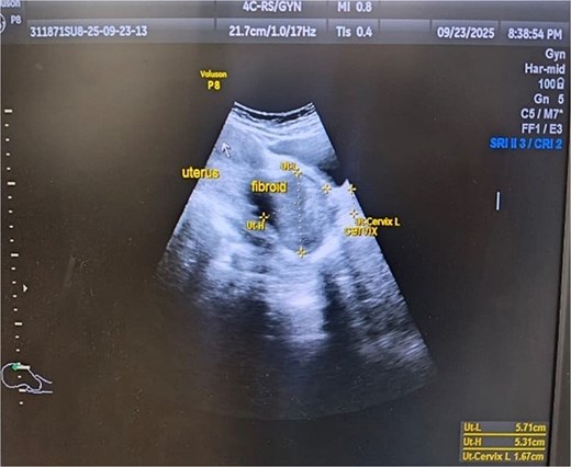 Ultrasonographic image of fibroid polyp of size 5.71 cm × 5.31 cm.