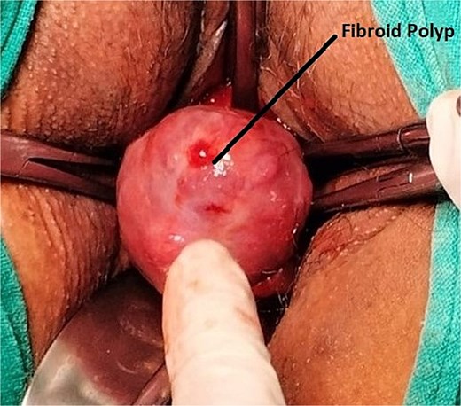 Intra-operative image of Case 3 – cervical fibroid polyp mimicking a malignant mass.