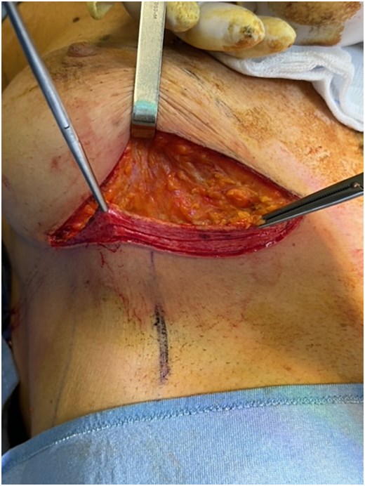 Inframammary skin incision with dermal flap.