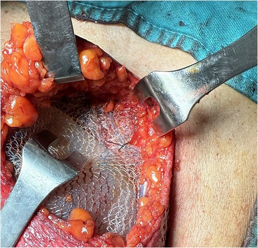 Anchoring the mesh to pectoralis fascia.