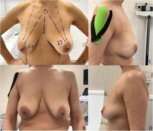 Preoperative photo (A) and postoperative control after 18 months (B–D).