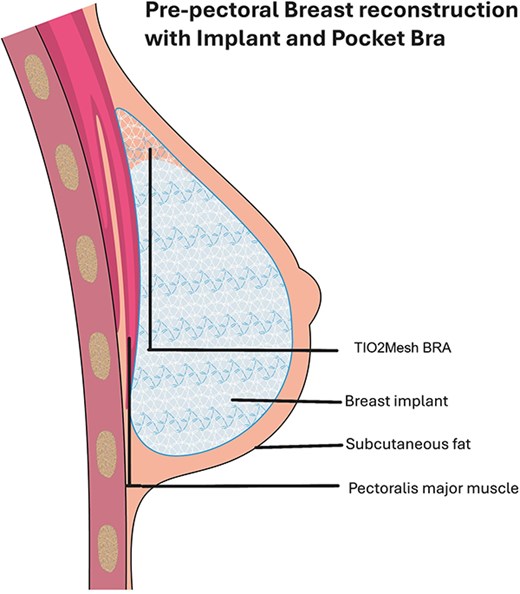Illustration of position of mesh and implant.
