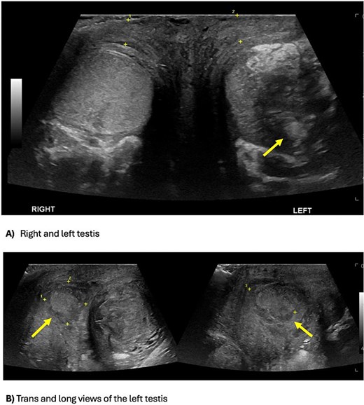 Scrotal ultrasound images showing left sided testicular abscess.