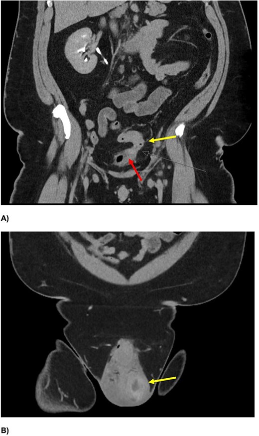Computed tomographic intravenous pyelogram slices demonstrating a colovesical fistula and left testicular-scrotal abscess.