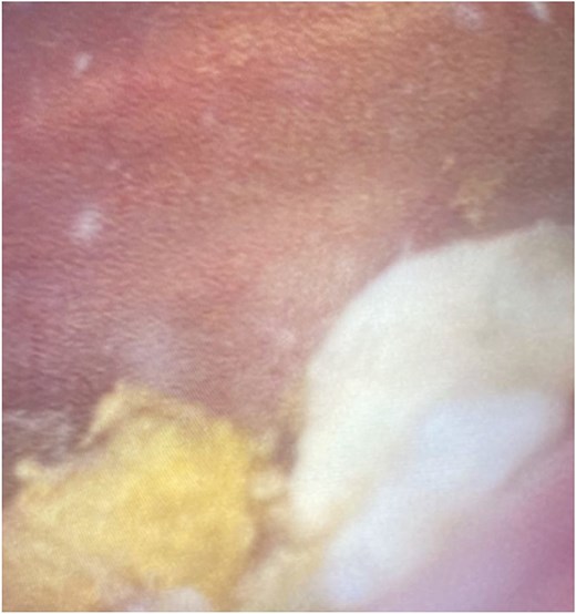 Cystoscopy image demonstrating faeces in the bladder.