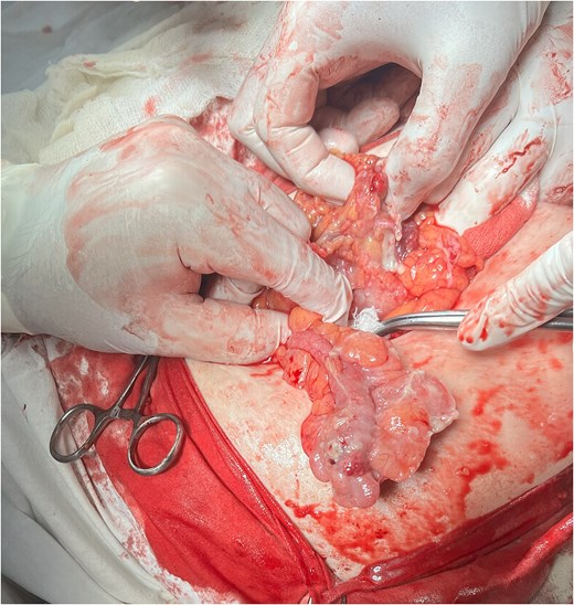 Intraoperative view showing the inflamed appendix freed from the hernial sac.