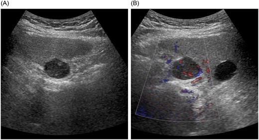 Abdominal ultrasonography findings. (A) A well-defined, smooth-surfaced hypoechoic mass measuring ~23 × 19 mm protruding beneath the hepatic dome in segment 8. (B) The lesion contains an anechoic area and a solid component with pulsatile flow.