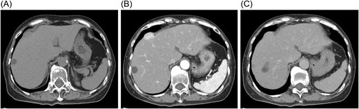 Contrast-enhanced computed tomography findings. (A) The mass is located beneath the hepatic dome in segment 8 and protrudes extrahepatically. (B) The lesion shows early enhancement in the arterial phase. (C) Prolonged enhancement persists into the equilibrium phase without obvious washout.