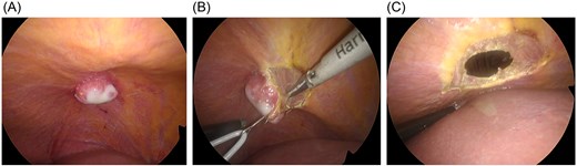 Intraoperative findings. (A) After division of the falciform ligament and mobilization of the liver, no tumor is observed on the hepatic surface; a localized white nodular lesion is identified on the diaphragm beneath the hepatic dome. (B) The tumor shows no continuity with the liver parenchyma and is diagnosed intraoperatively as a diaphragmatic tumor. Partial diaphragmatic resection is performed. (C) The diaphragmatic defect is closed by primary suturing after tumor resection.