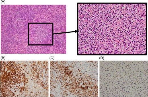 Histopathological findings. (A) Diffuse infiltration of lymphocytes and plasma cells with scattered follicle-like structures containing large, atypical cells (hematoxylin and eosin staining). (B) Tumor cells show positivity for smooth muscle actin. (C) Proliferation of CD23-positive cells is observed. (D) In situ hybridization demonstrates positivity for Epstein–Barr virus–encoded RNA (EBER), confirming EBV infection.