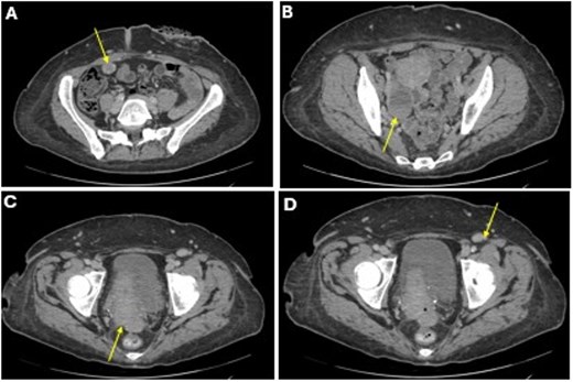 A CT imaging showing lesions involving the right abdominal wall (A), right ovary (B), right anterior reflection of the rectum (C), and left inguinal lymph node (D).