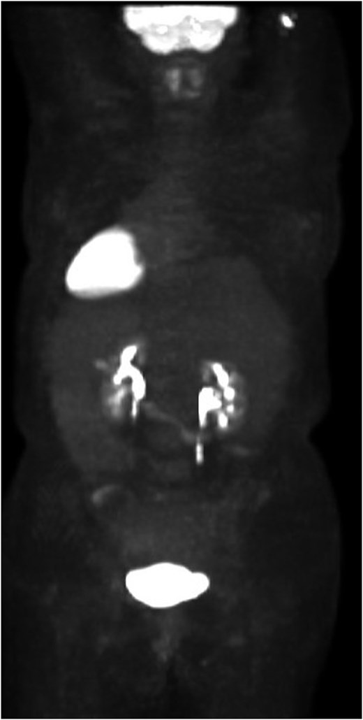 Patient’s preoperative PET scan, which demonstrates no significant hypermetabolic parenchymal lesions, lymph nodes, or masses.