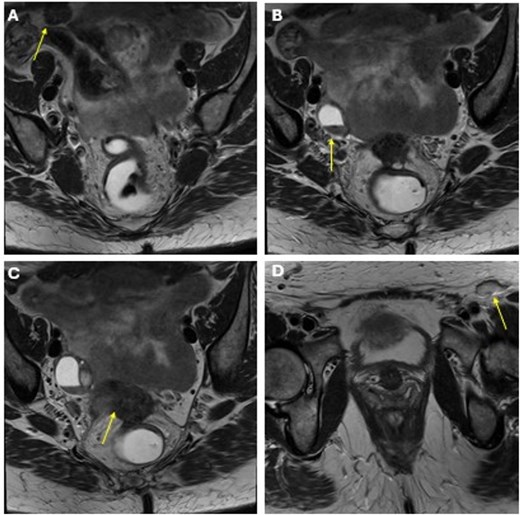 MRI obtained status post 20 cycles of adjuvant pembrolizumab with a stable-appearing mass abutting the right rectus abdominis (A), right adnexal masses (B), a mass along the anterior peritoneal reflection abutting the rectum (C), and a left inguinal lymph node (D).