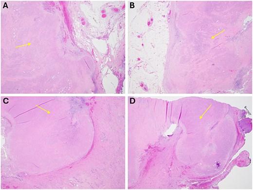 Final representative sections of the abdominal wall (A/B) and cervix (C/D) viewed at 2x power, demonstrating a pink, necrotic mass that is devitalized without viable tumour, with surrounding benign fibroadipose tissue and cervical stroma, respectively.