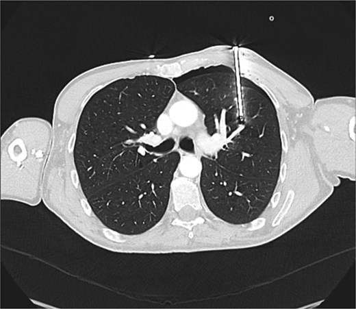 Axial CT thorax showing retained nail adjacent to pulmonary artery branch.