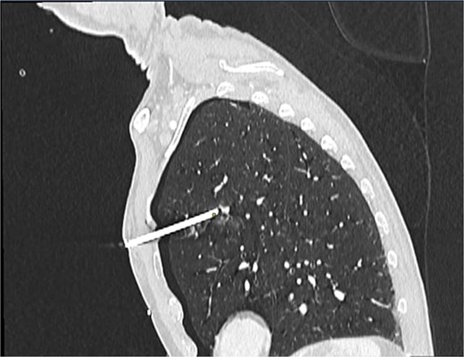 Sagittal CT thorax showing angle of entry of retained nail.