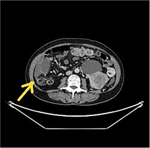 CT scan showed left RCC, appendix tumour with surrounding mucin.