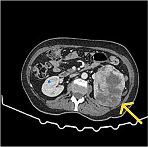 CT scan showed left RCC, appendix tumour with surrounding mucin.