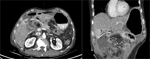 Cross-sectional image of jejunum perforation (black arrows) and transanastomotic pancreaticojejunostomy stent (black arrow heads).