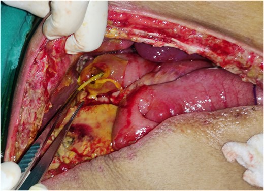 Jejunal perforation defect with stent through the perforation.