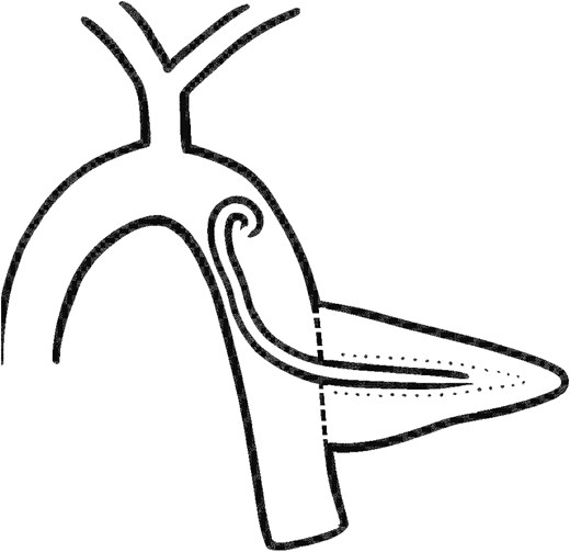 Improvised technique of single-J transanastomotic stent placement.