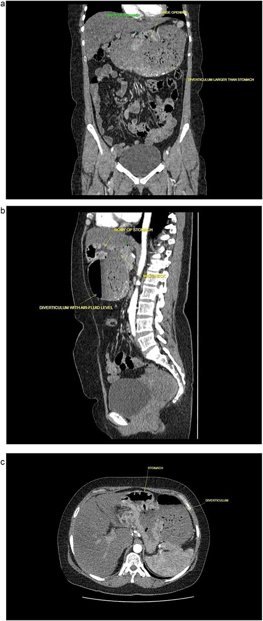 Contrast enhanced computed tomography (CECT) of abdomen and pelvis. (a) Sagittal plane. (b) Coronal plane. (c) Axial plane.